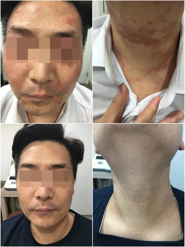 아토피 피부염 얼굴·목 치료 전후 비교