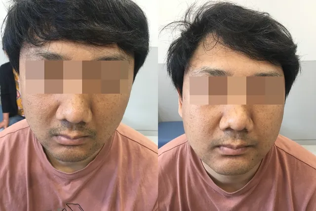 안면 피부 상태 치료 전후 비교