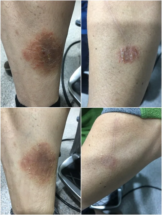 다리 피부 병변 치료 전후 비교