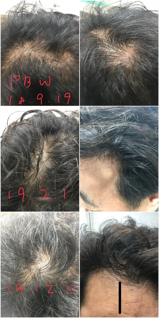 탈모 치료 경과 시점별 비교